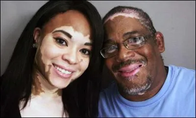 Quelle est cette maladie rare de la peau (voir photo) ?