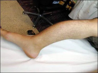 Souvent g&eacute;n&eacute;tiques, ce sont des maladies rares , orphelines, pour lesquelles on ne dispose d'aucun traitement efficace. Quelle est cette maladie orpheline qui rend les os extr&ecirc;mement fragiles.