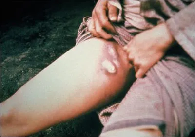 Du XIVe au XVIIe siècle, cette maladie aurait fait dans le monde plus de 100 millions de victimes ; laquelle ?