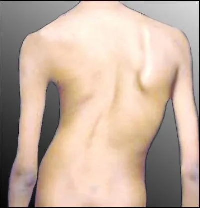 Sur cette image, quelle maladie observe-t-on ?