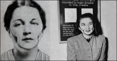 Pour avoir un beau sourire, le port de cet appareil était conseillé. On dirait un instrument de torture mais c'est un ...