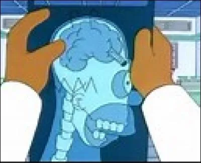 Homer Simpson est devenu intelligent quand on lui a retiré un pastel du cerveau .