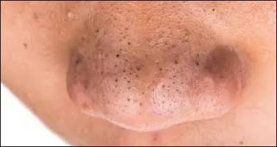 Vrai ou faux ? On ne peut pas avoir de points noirs sur le visage.