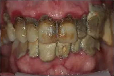 Chez l'humain, de quelle matière est constituée la partie externe de la dent ?