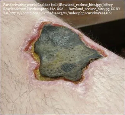 Ma morsure peut provoquer une nécrose des tissus, une gangrène trouant la chair jusqu'aux os et détruire les artères et les veines. Je suis...