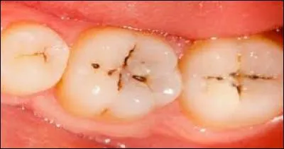 - Bravo ! Montons plutôt sur les dents. Faites attention. Aimez-vous les bonbons ? Vous en voyez ici la conséquence. Quel est donc cet espace noir au milieu de la dent, souvent ?