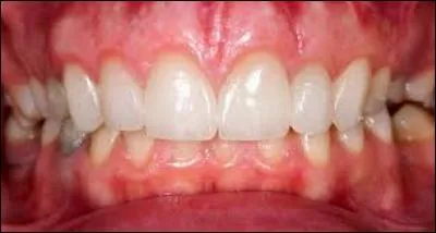 - Regardez ce beau rose ! Là, sur le côté, il s'agit de l'intérieur des joues, en réalité. Au-dessus des dents, quelle est cette partie d'un beau rose dû à la présence de la kératine ?