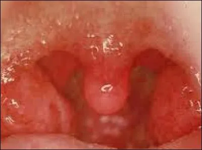 - Restez sur place. À gauche et à droite de l'élément que vous venez d'identifier, vous avez les amygdales. Peut-être les connaissez-vous ? Ou plutôt, peut-être avez-vous entendu parler de l'amygdalectomie ou ablation des amygdales. Savez-vous pourquoi on opère des amygdales, bien souvent ?