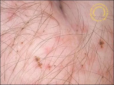 Cela vous est peut-être arrivé, à vous ou à vos enfants,"la phtiriase ou ... .