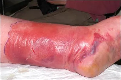 C'est une infection aiguë de la peau due à un streptocoque, c'est ... .