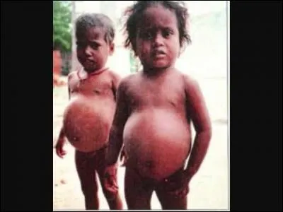 Un drôle de nom pour une maladie qui touche les enfants, "le Kwashiorkor". Qu'est-ce au juste ?