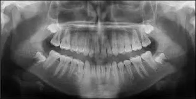 À quel âge Enzo s'est-il fait enlever les dents de sagesse ?