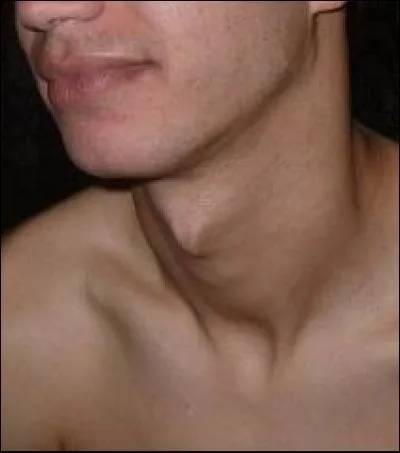 Comment appelle-t-on cette partie visible au niveau de la gorge du cartilage de la thyroïde ?