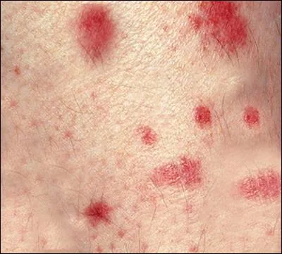 L'ao&ucirc;tat est un petit arachnide jaune piqueur suceur de sang.