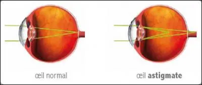 L'astigmatisme est un trouble de la vision qui empêche de voir correctement ...
