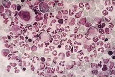 De quoi la leucémie est-elle le cancer ?