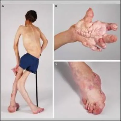 De quelle maladie souffrent ces personnes ?