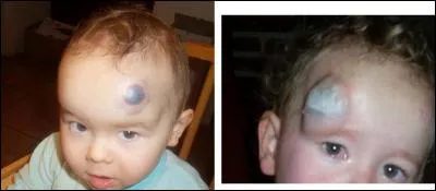 Quelle maladie ont ces jeunes garçons ?