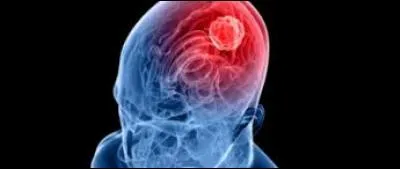 Cet homme a un cancer du cerveau.
