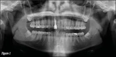 Les dents de sagesse ne poussent pas.