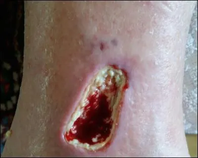 Cette vilaine plaie a été causée par...