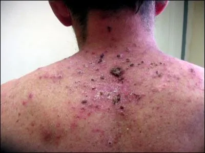 Qui est responsable de la gale ?