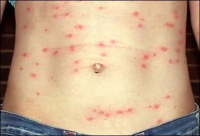 Sur la photo de présentation, vous voyez un torse couvert de piqûres d'insecte. De quel insecte s'agit-il ?