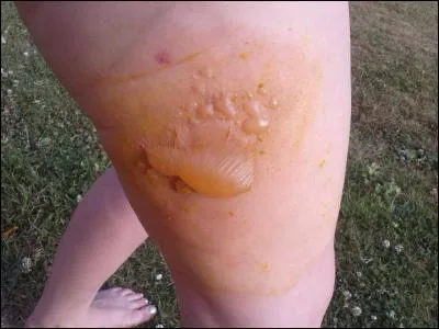 Vous voyez en photo les effets d'une morsure de taon, La femelle est hématophage, qu'est-ce que cela signifie ?