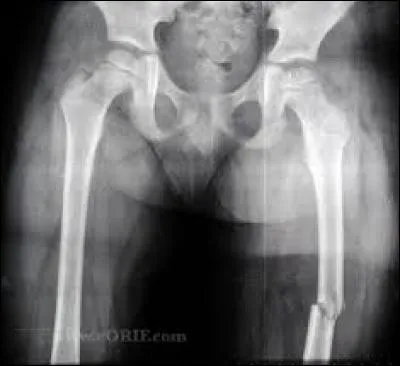 Comment s'appelle l'os de la cuisse ?