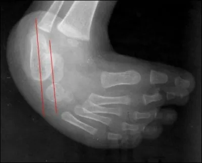 Quel est votre diagnostic après avoir interprété cette radio ?