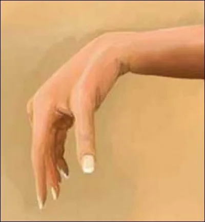 Comment s'appelle cette déformation de la main ?