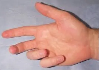Ce patient a des rétractions au niveau des muscles fléchisseurs des doigts. Quel est le nom de cette maladie ?
