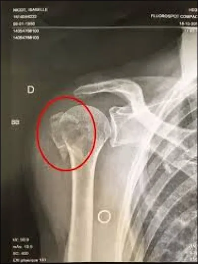 J'ai une col&egrave;gue qui a fait une chute dans l'escalier ! La pauvre, elle s'est tordue l'hum&eacute;rus !