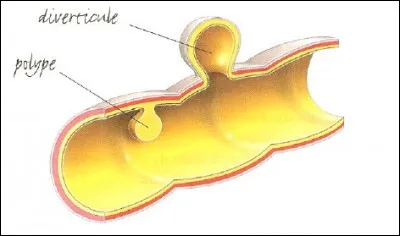 Qu'est-ce qu' un "diverticule" ?