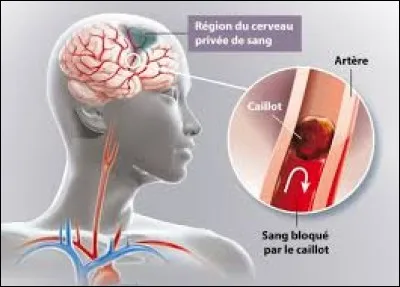 Vous avez 1/28 de risques de décéder d'un AVC. Quelle est la signification de cet acronyme ?