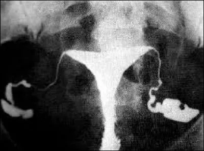 Je dois passer une __ pour être fixée sur ma stérilité.