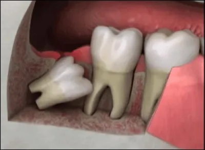 Lorsque les dents de sagesse sont bloquées et ne peuvent pas sortir, on dit qu'elles sont ...