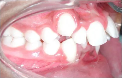 Quel spécialiste doit-on consulter pour porter un appareil dentaire ?