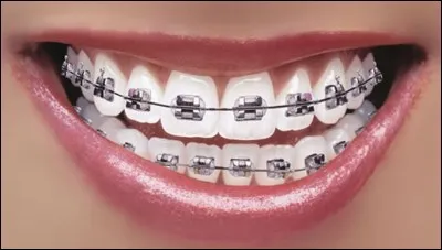 Un adulte peut-il porter un appareil dentaire ?