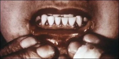 Quelle est la maladie provoquée par un manque en vitamine C ?