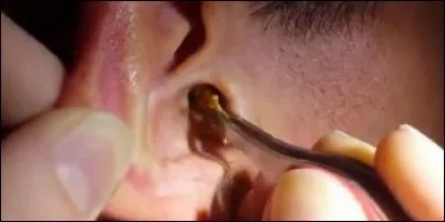 Que secrète l'oreille ?